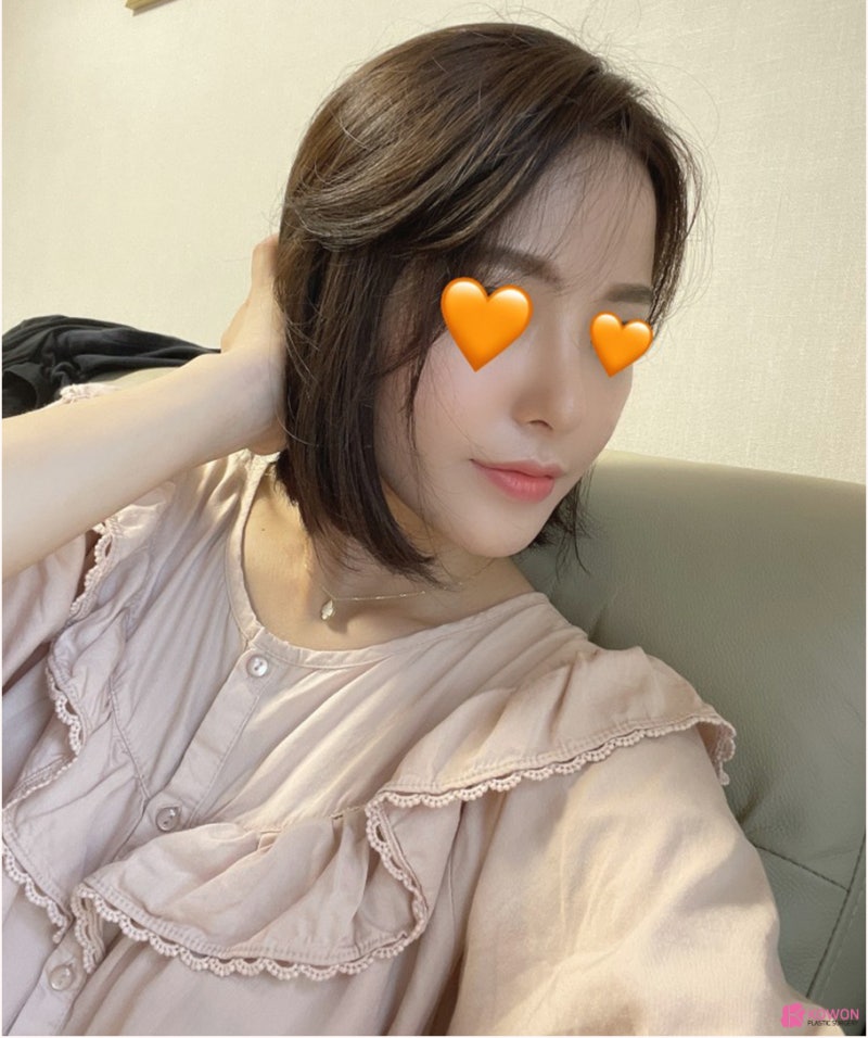 신논현역성형외과 낮고 짧은코 콤플렉스 해결 사진 11