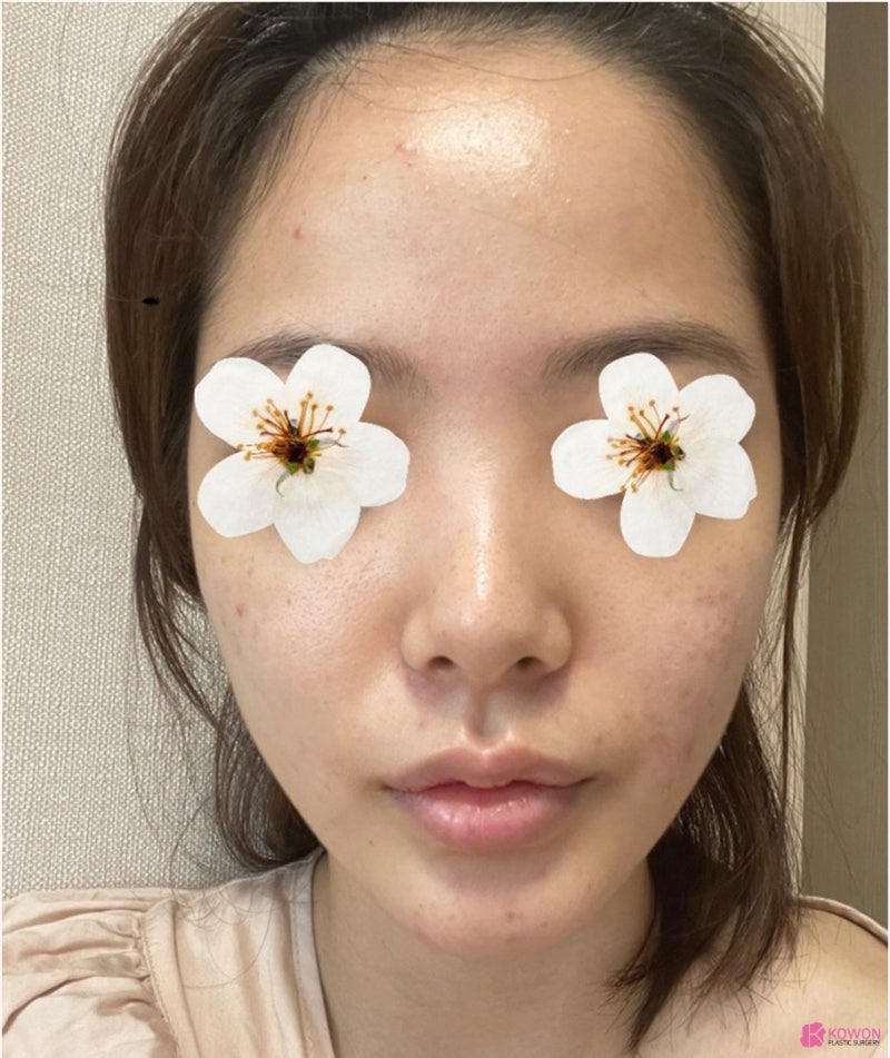 신논현역성형외과 낮고 짧은코 콤플렉스 해결 사진 3