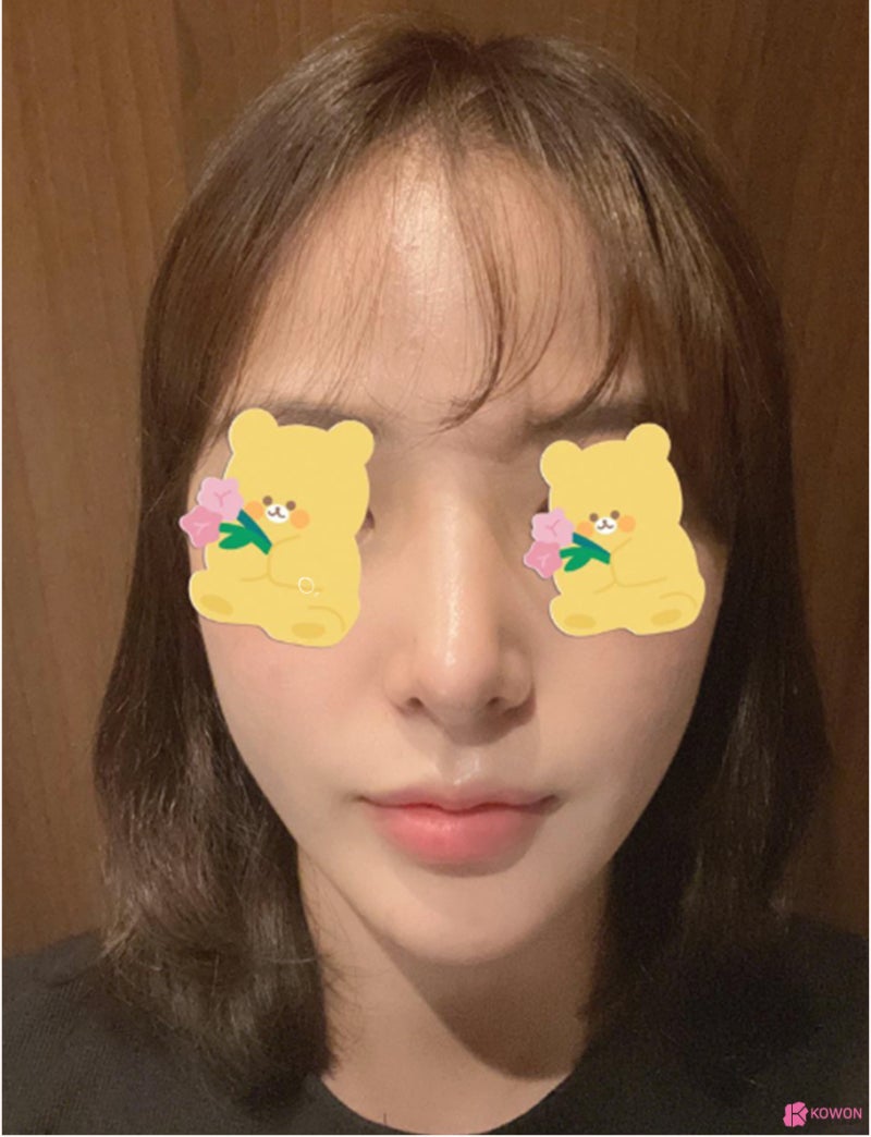 신논현역성형외과 낮고 짧은코 콤플렉스 해결 사진 7