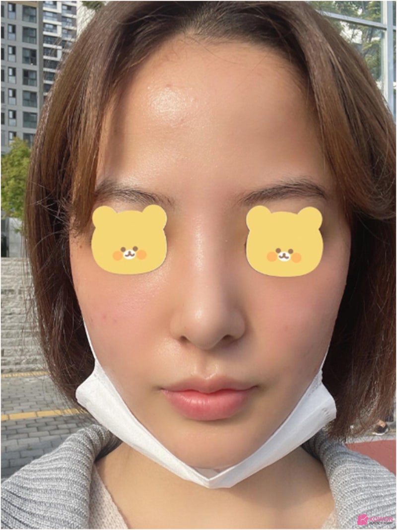 신논현역성형외과 낮고 짧은코 콤플렉스 해결 사진 9