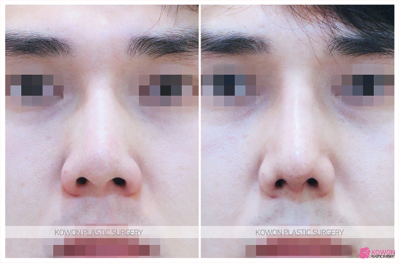 압구정코수술 이목구비 조화롭게 만든 낮은코성형후기 사진 8