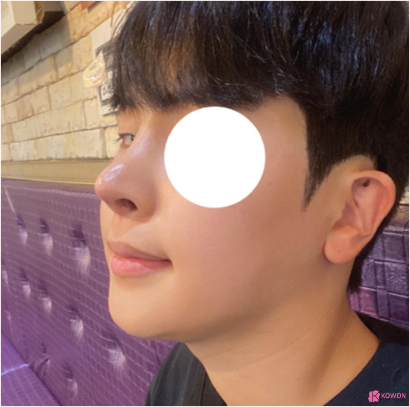 코재수술병원 비주튀어나옴 직선코라인 교정 사례 사진 13