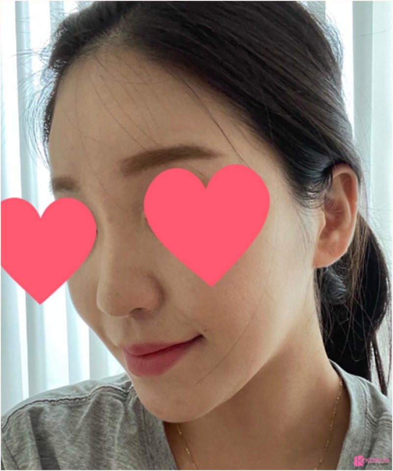 강남코성형잘하는곳 기능코수술 전후 사진 사진 2