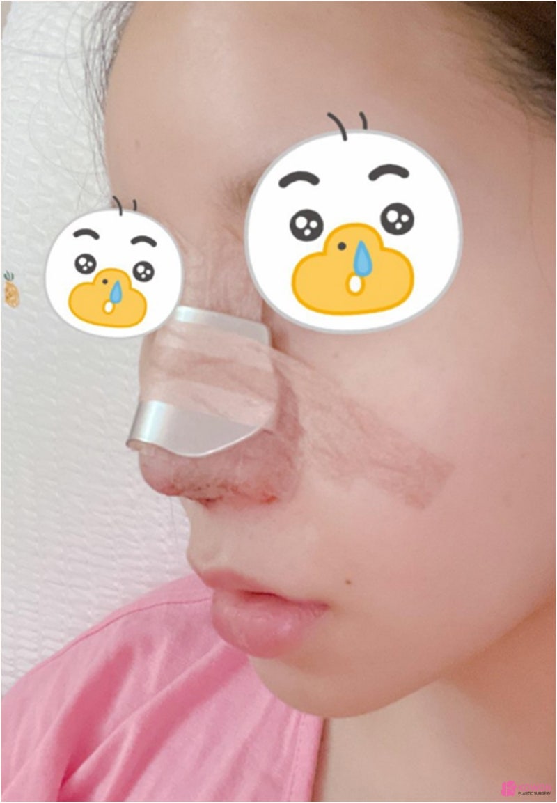 강남코성형잘하는곳 기능코수술 전후 사진 사진 5