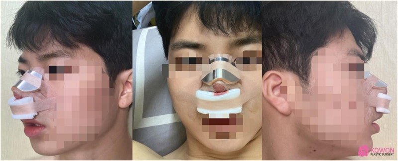 강남코수술 자가늑연골로 진행한 개방코성형 사례 사진 3