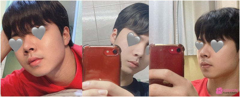 강남코수술 자가늑연골로 진행한 개방코성형 사례 사진 10