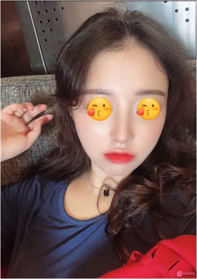 서울청담성형외과 코수술 귀연골 사용한 방법 사진 4