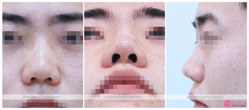 신사동성형외과 이목구비 선명해진 복코수술후기 사진 2