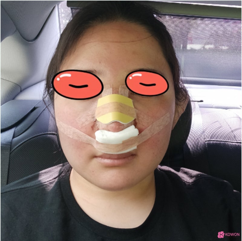 청담동성형외과 복코 콤플렉스 코지방제거 후 해결 사진 6