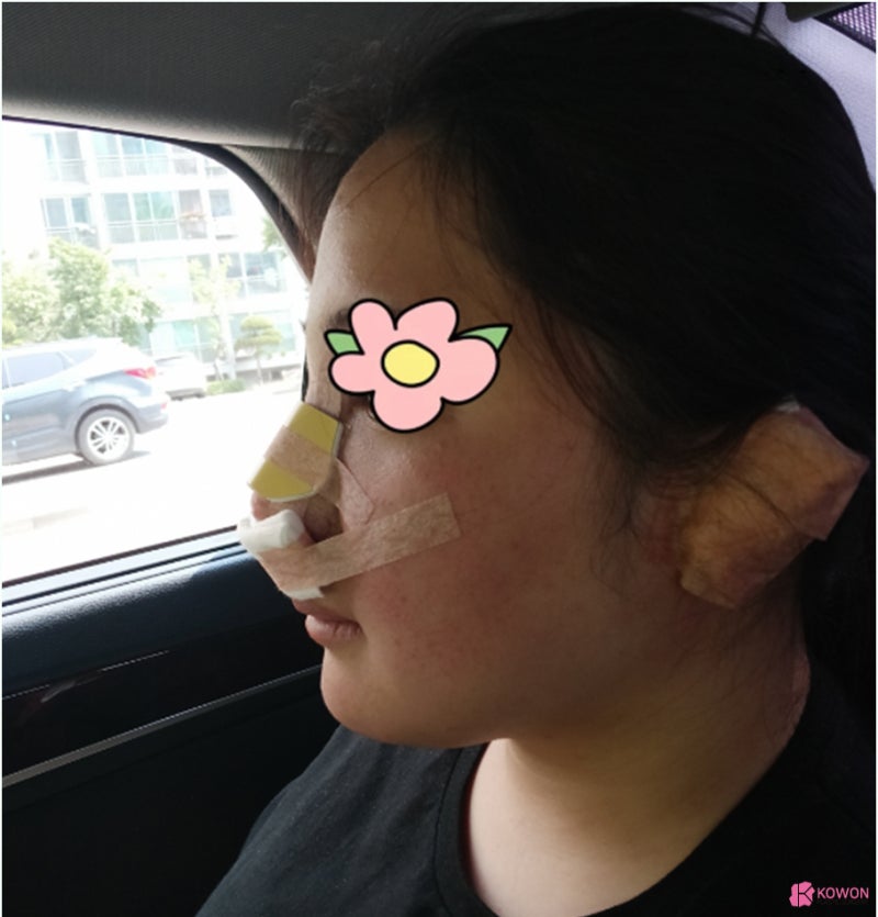 청담동성형외과 복코 콤플렉스 코지방제거 후 해결 사진 7