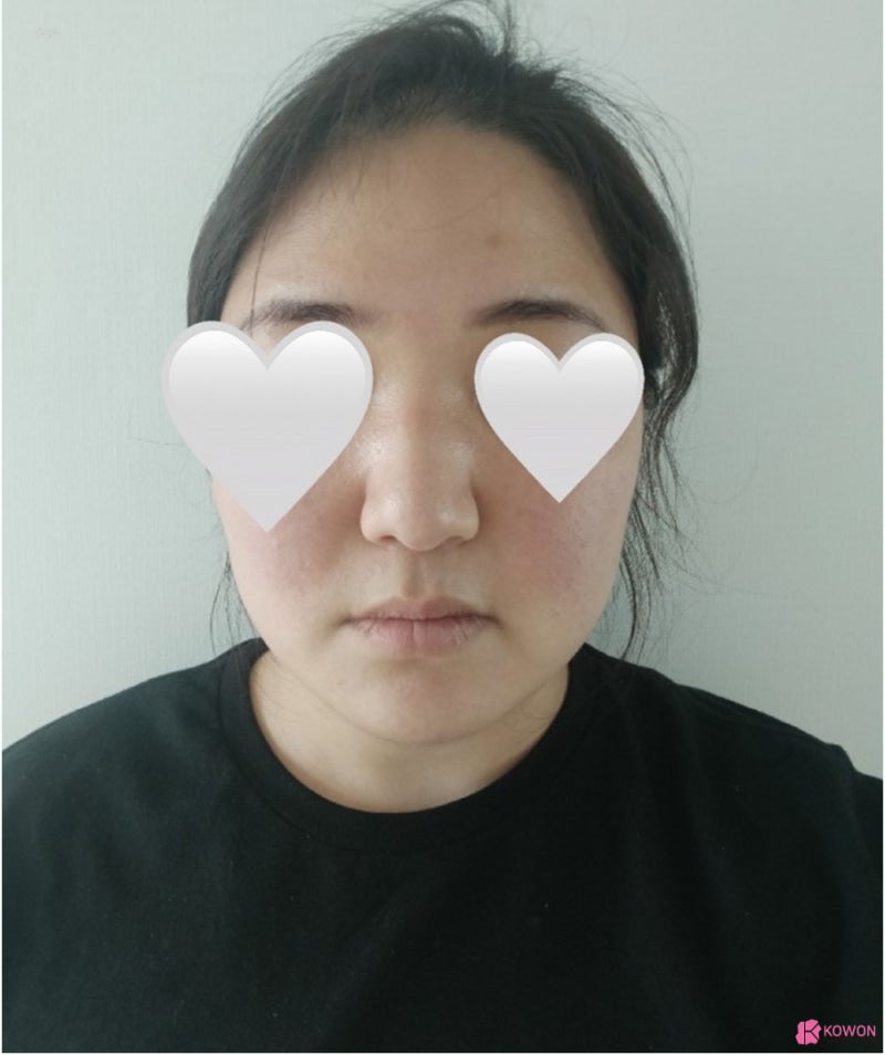 청담동성형외과 복코 콤플렉스 코지방제거 후 해결 사진 4