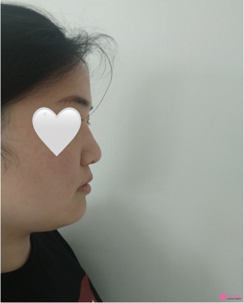 청담동성형외과 복코 콤플렉스 코지방제거 후 해결 사진 2