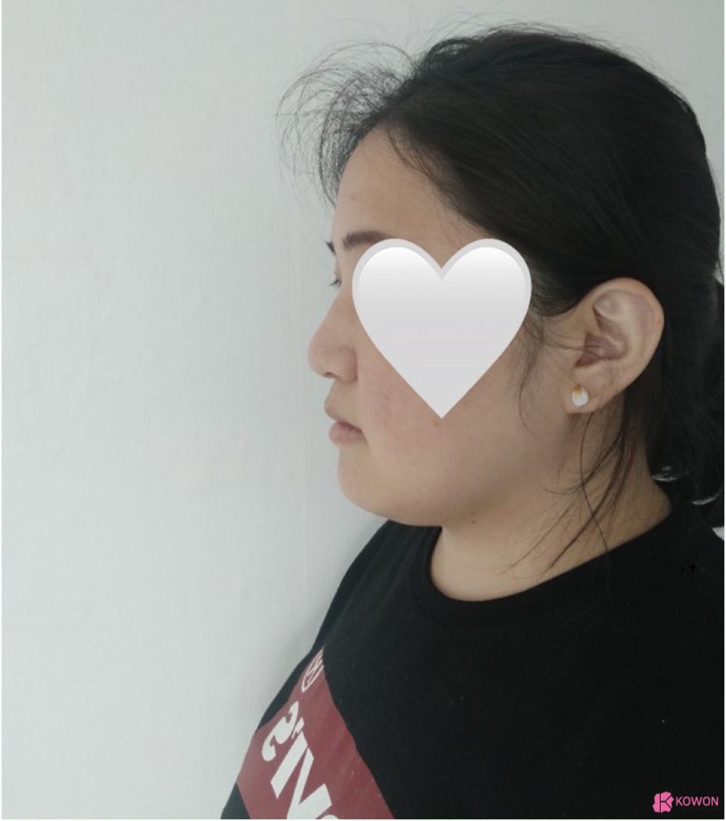 청담동성형외과 복코 콤플렉스 코지방제거 후 해결 사진 3