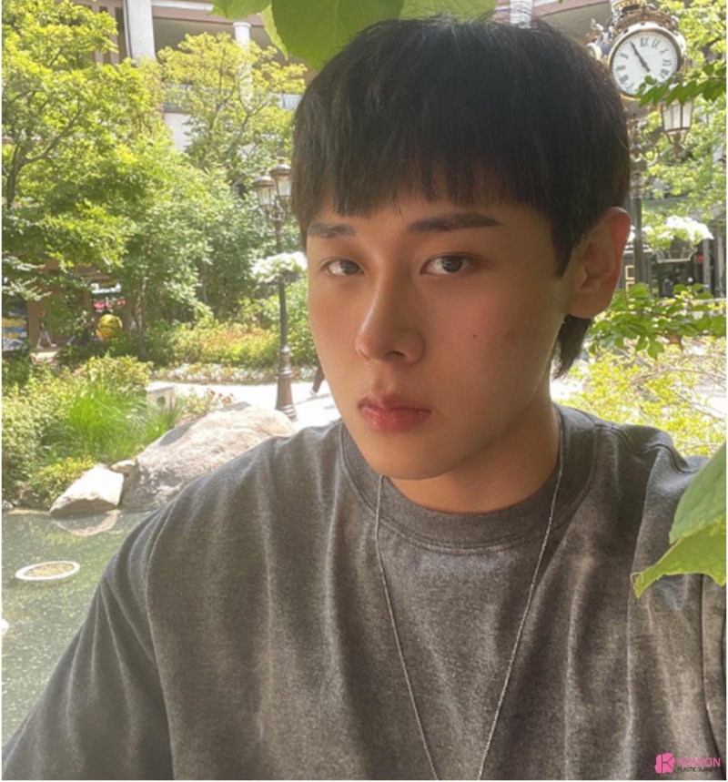 신사성형외과 남자 비염코수술 사례 사진 8