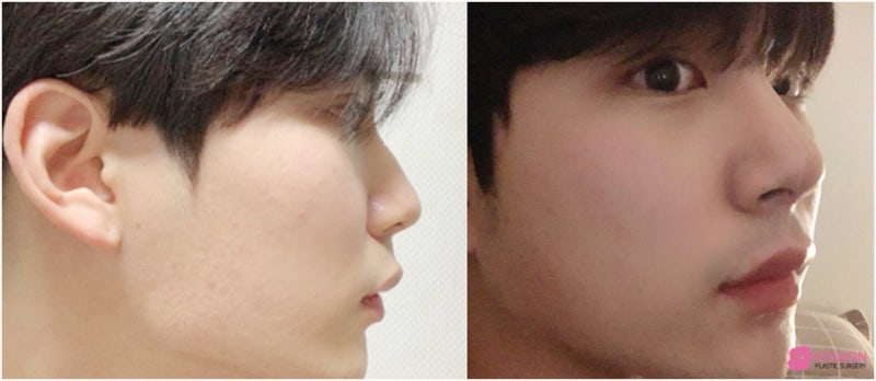 압구정코성형 비중격교정술 매부리코 콤플렉스 해결