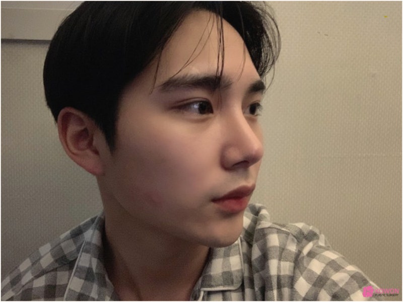 압구정코성형 비중격교정술 매부리코 콤플렉스 해결 사진 5
