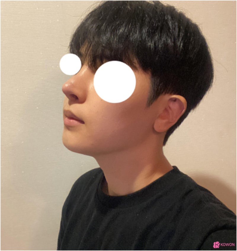 코수술성형외과 남자 코끝들림 재수술 사례 사진 10