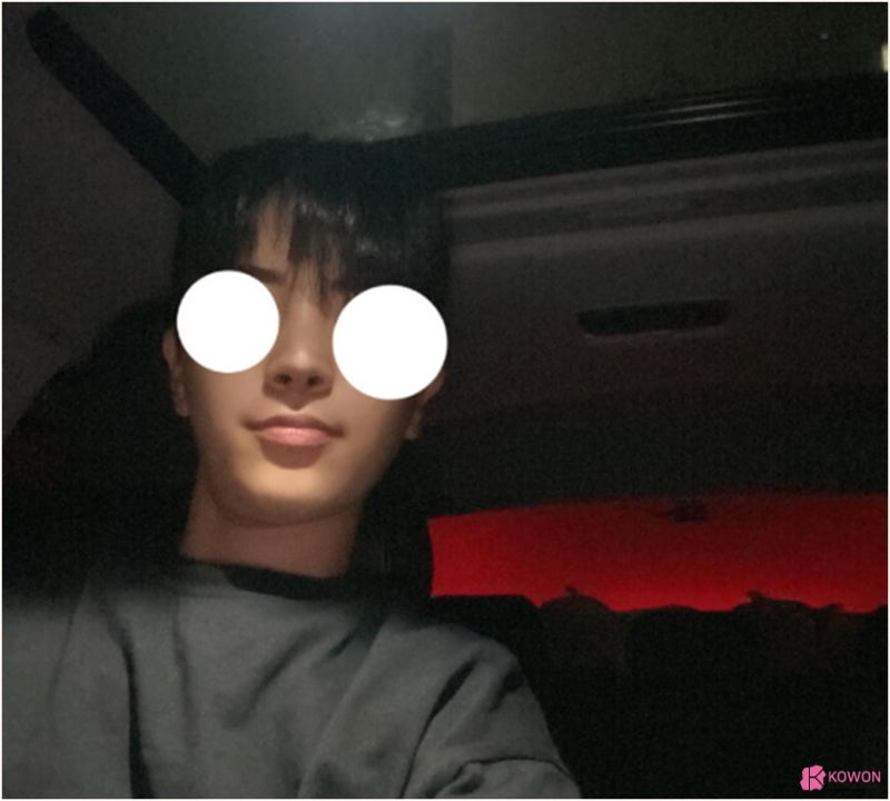 코수술성형외과 남자 코끝들림 재수술 사례 사진 11