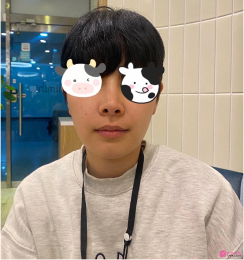 코수술성형외과 남자 코끝들림 재수술 사례 사진 3