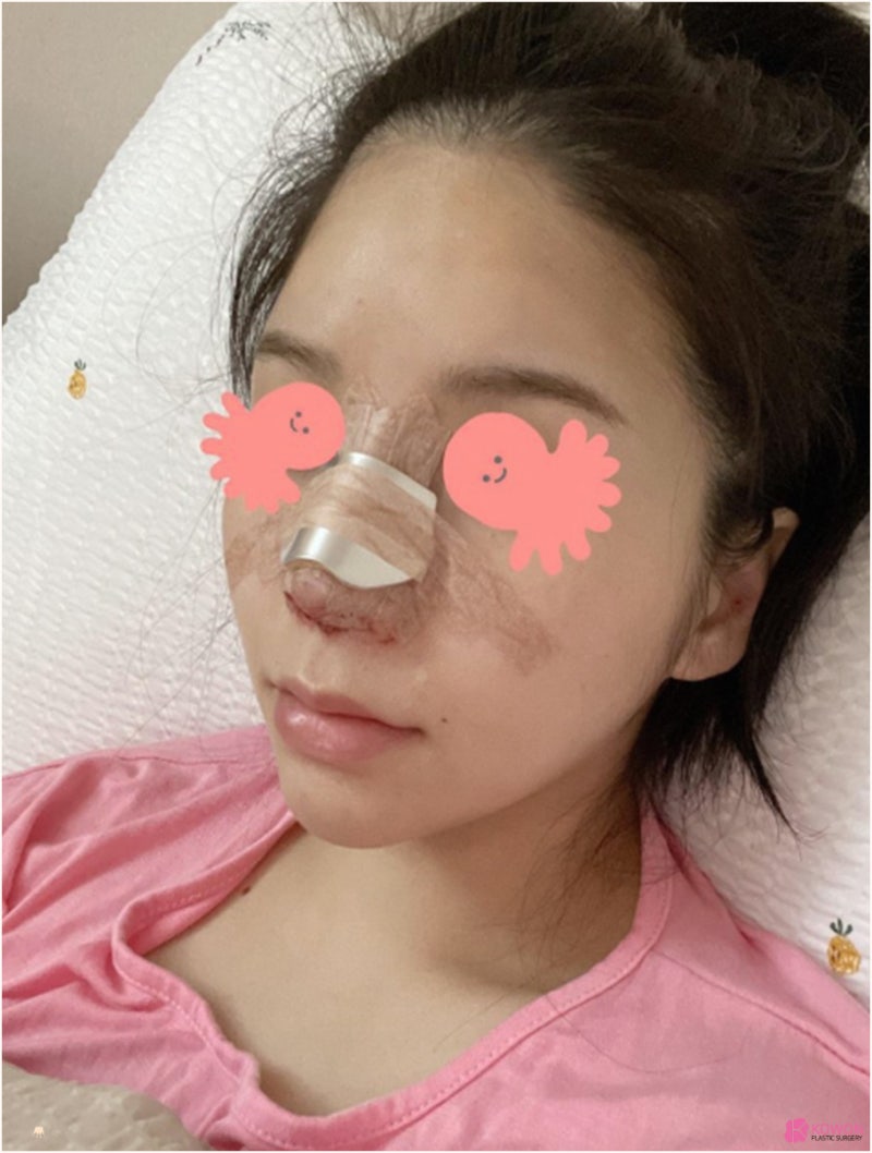 기능코성형외과 콧대높이기 수술 후 경과 사진 6