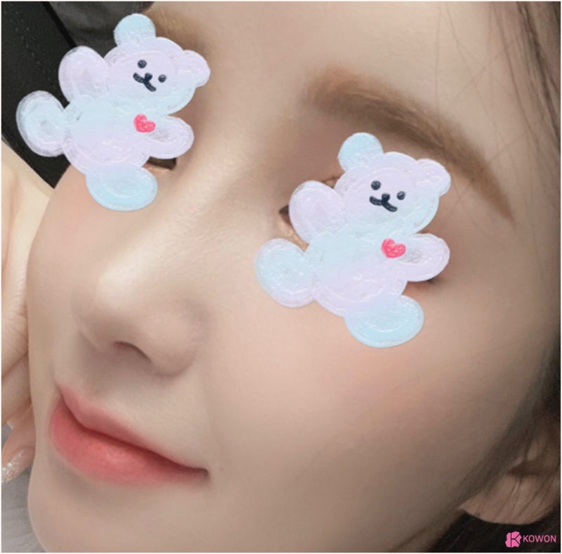 기능코성형외과 콧대높이기 수술 후 경과 사진 7