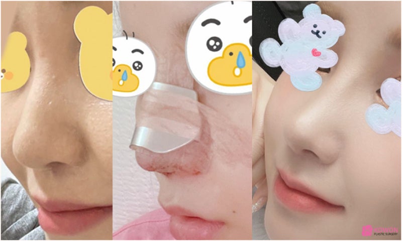 기능코성형외과 콧대높이기 수술 후 경과