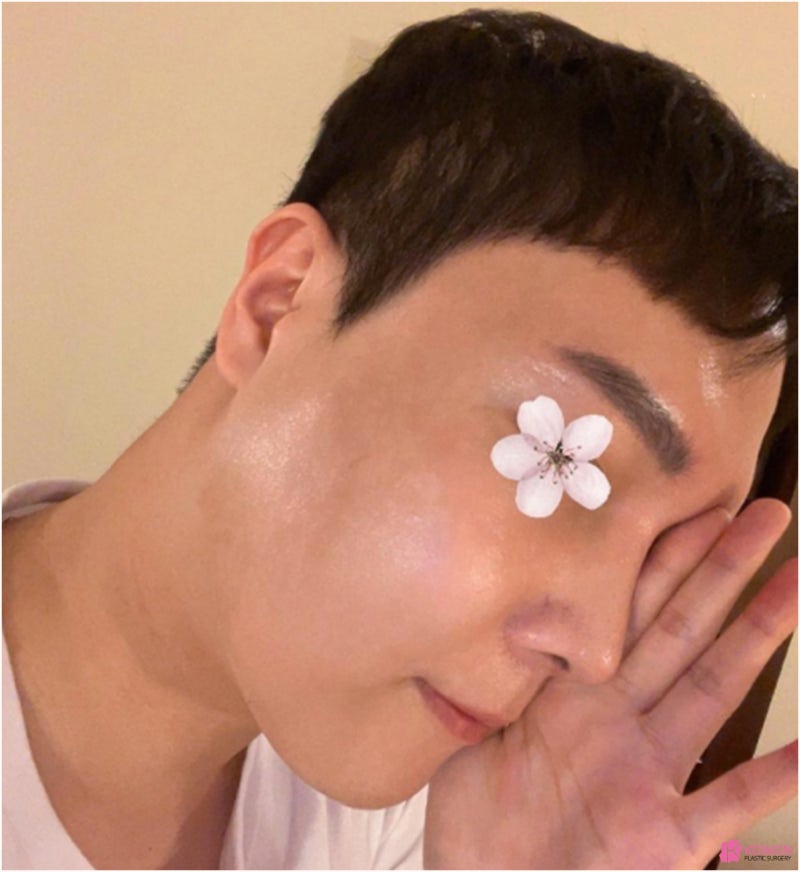 코재수술병원 휘어진 코 코끝구축 교정도 자연스럽게 사진 7