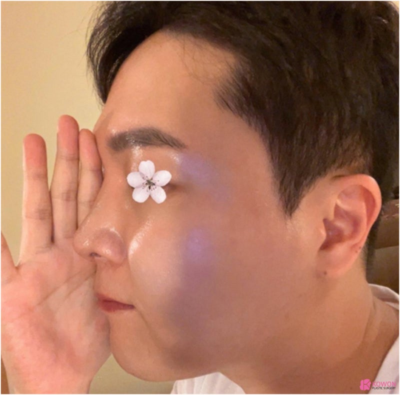 코재수술병원 휘어진 코 코끝구축 교정도 자연스럽게 사진 8