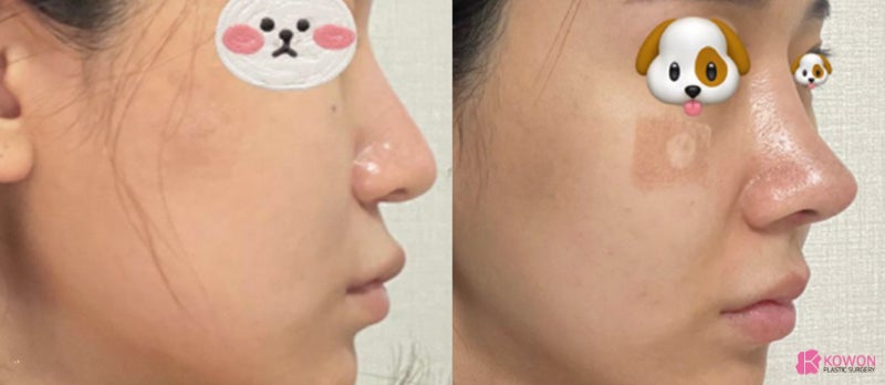 코재수술성형외과 코수술알러지 테스트 후 안전하게 사진 10