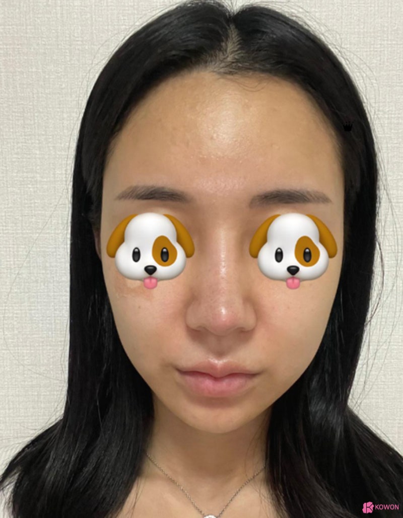 코재수술성형외과 코수술알러지 테스트 후 안전하게 사진 7