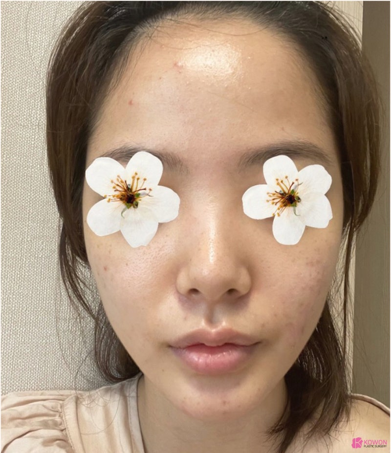 코재수술잘하는병원 들린코 직반버선 라인으로 개선 사진 3