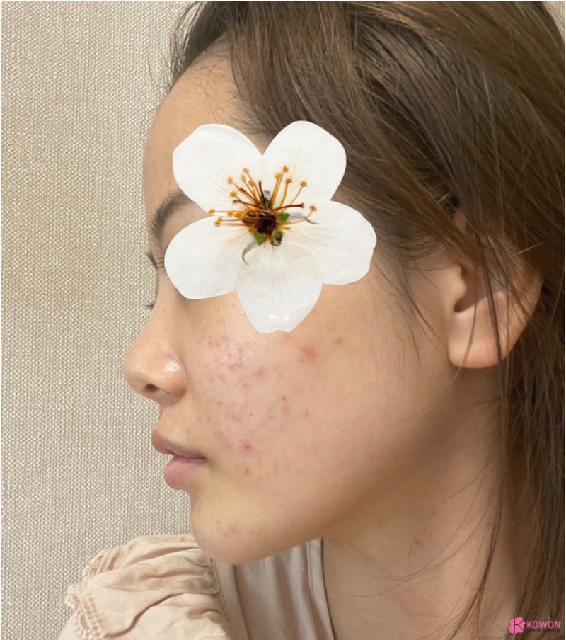 코재수술잘하는병원 들린코 직반버선 라인으로 개선 사진 2