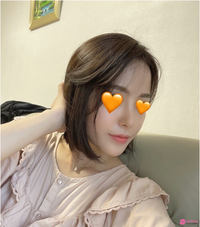 코재수술잘하는병원 들린코 직반버선 라인으로 개선 사진 11