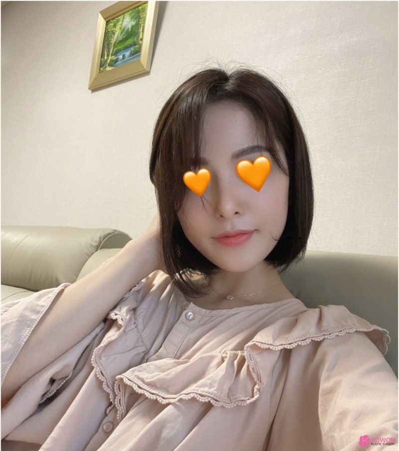 코재수술잘하는병원 들린코 직반버선 라인으로 개선 사진 12