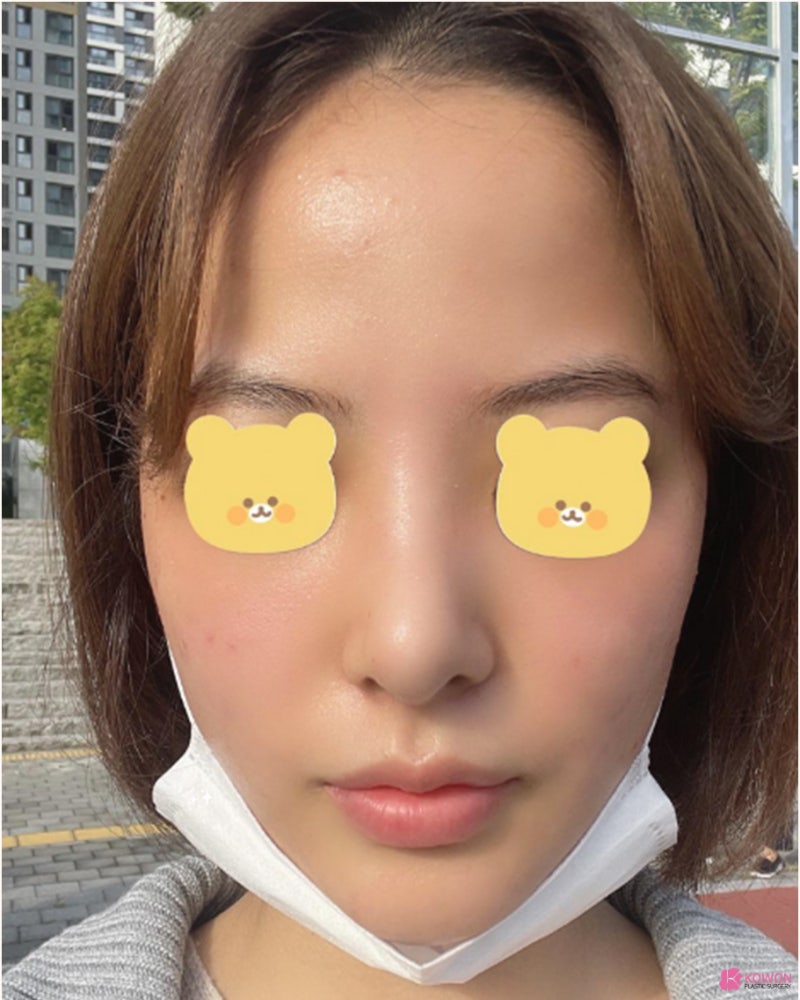 코재수술잘하는병원 들린코 직반버선 라인으로 개선 사진 8