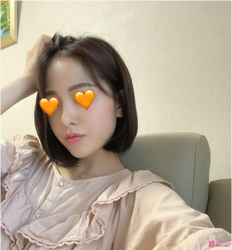 코재수술잘하는병원 들린코 직반버선 라인으로 개선 사진 13