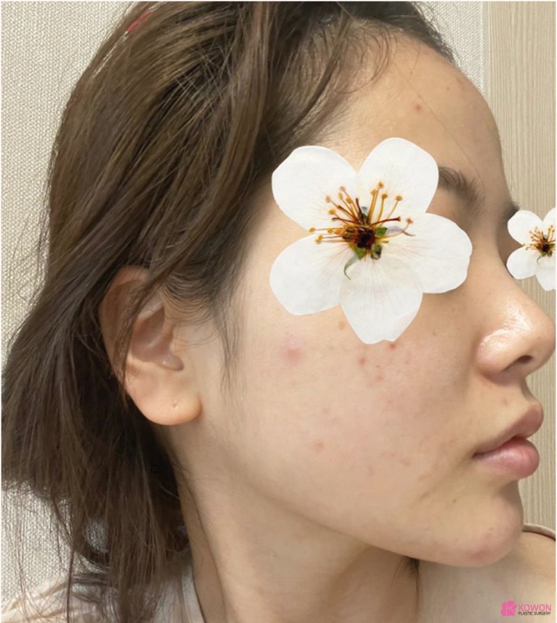 코재수술잘하는병원 들린코 직반버선 라인으로 개선 사진 4