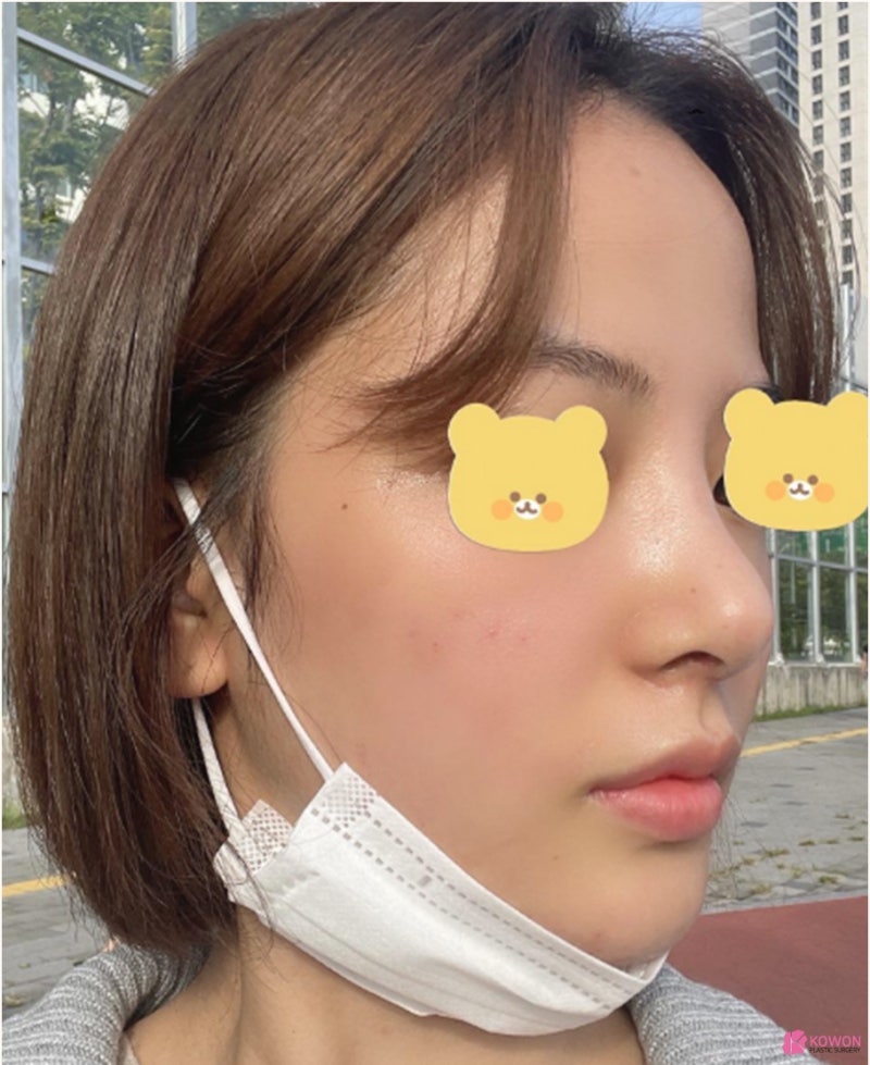 코재수술잘하는병원 들린코 직반버선 라인으로 개선 사진 9