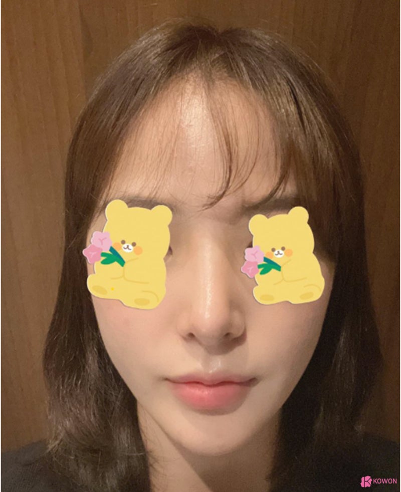 코재수술잘하는병원 들린코 직반버선 라인으로 개선 사진 7