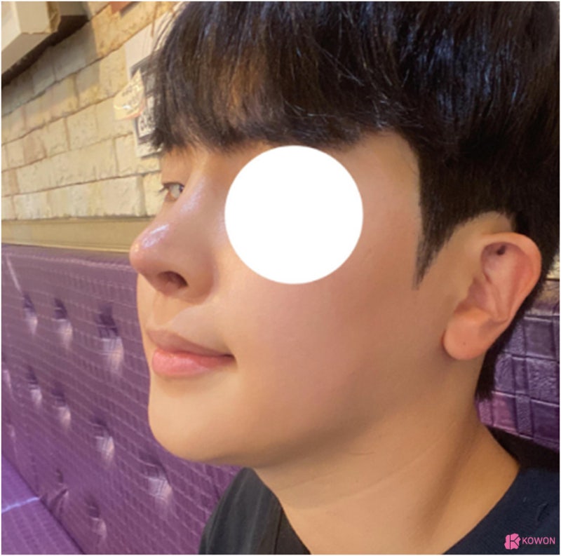 코수술잘하는곳 남자 코끝들림 직선코 라인으로 사진 13