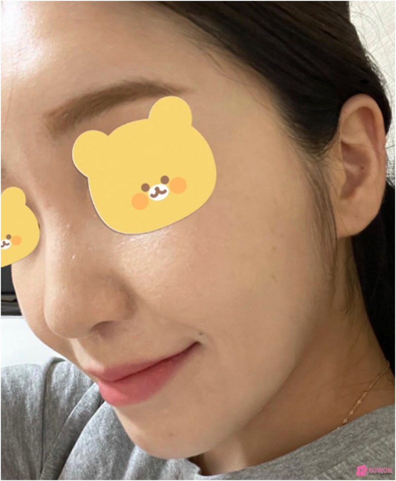 코성형전문성형외과 콧대높이기 전후 비교 사진 사진 3