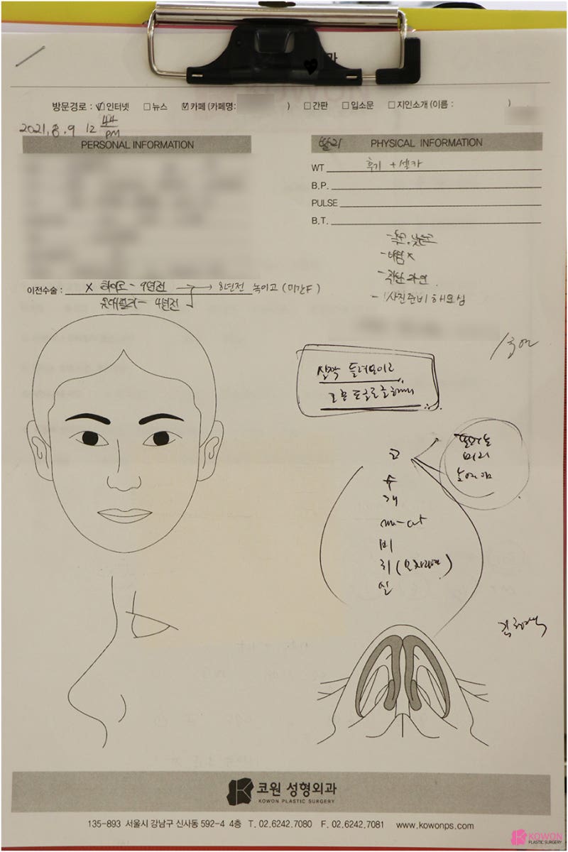 코성형전문성형외과 콧대높이기 전후 비교 사진