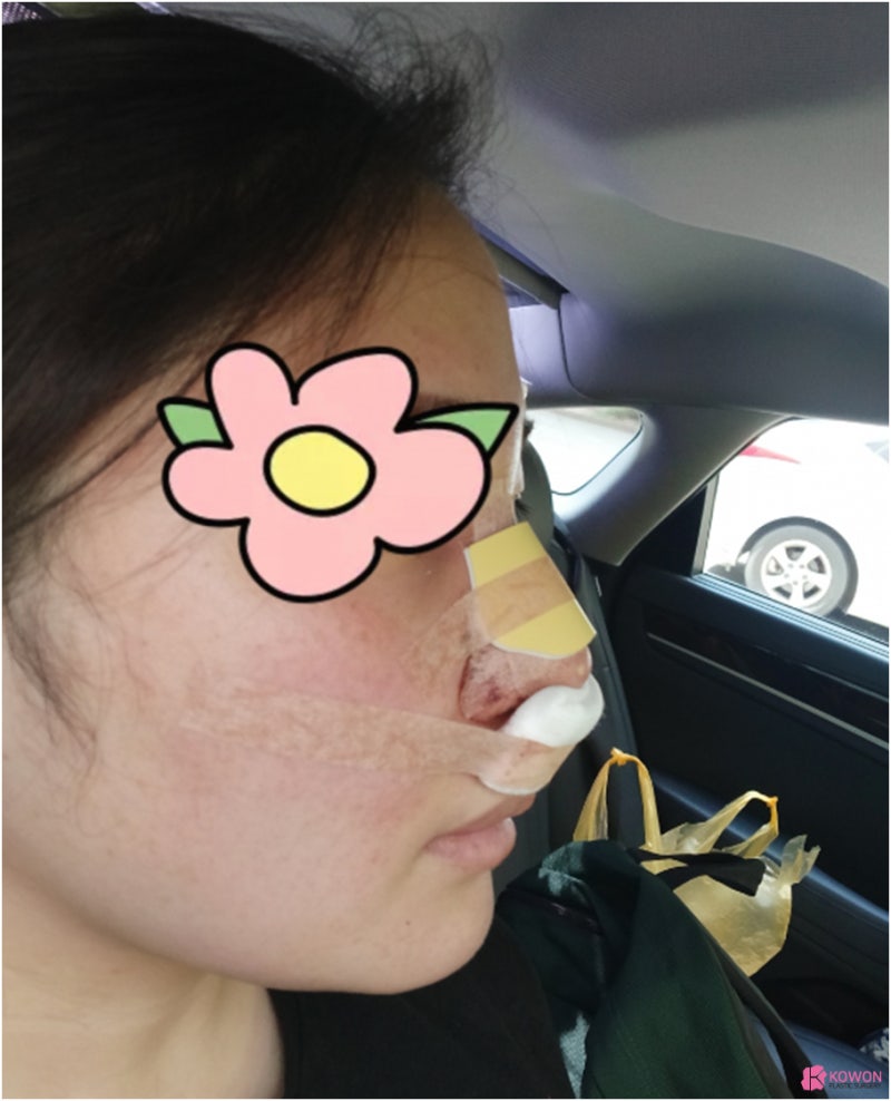 코성형외과유명한곳 동글동글한코 콤플렉스 해결 사진 5