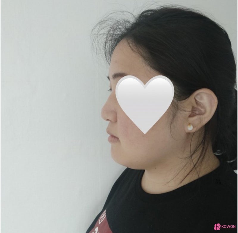 코성형외과유명한곳 동글동글한코 콤플렉스 해결 사진 3