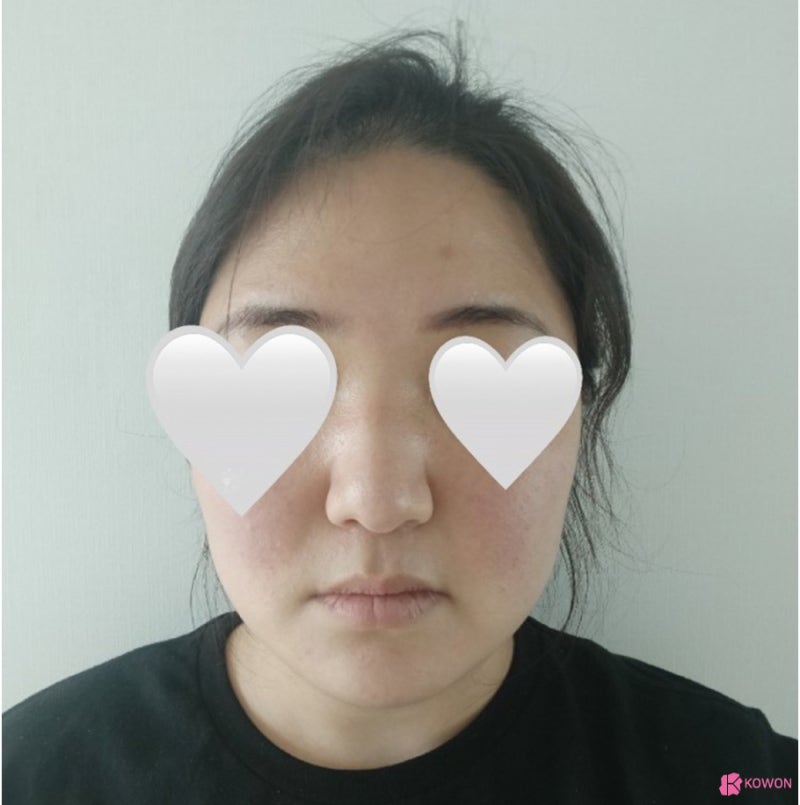 코성형외과유명한곳 동글동글한코 콤플렉스 해결 사진 4