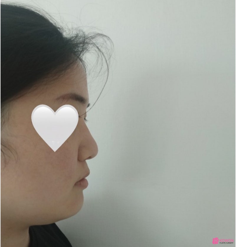 코성형외과유명한곳 동글동글한코 콤플렉스 해결 사진 2