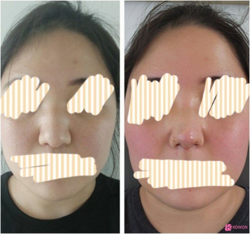 코성형외과유명한곳 동글동글한코 콤플렉스 해결 사진 8