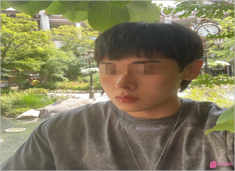 강남코수술잘하는곳 뭉툭한코 수술 후기 사진 8