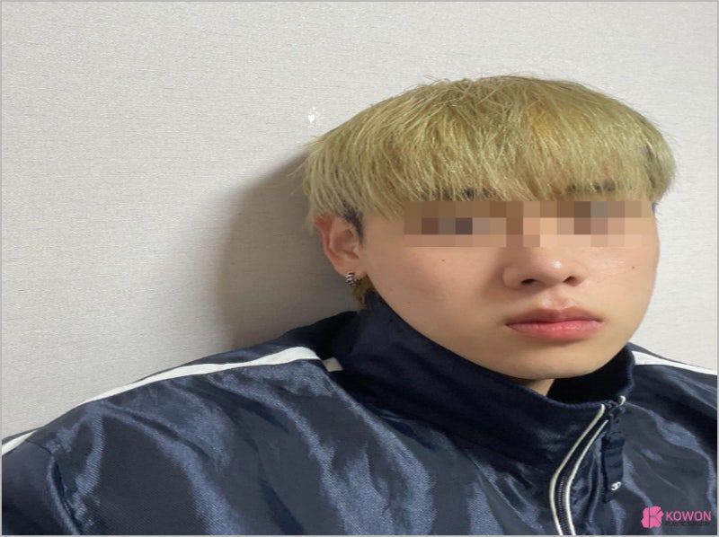 강남코수술잘하는곳 뭉툭한코 수술 후기 사진 13