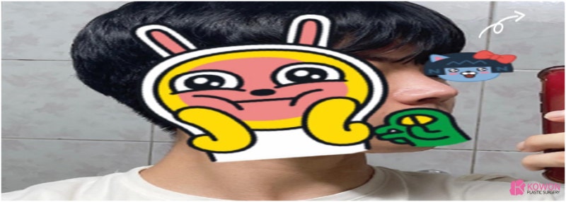 코성형병원 남자 복코전후 비교 사진 사진 9